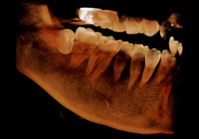 水平埋伏歯3D像