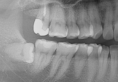 水平埋伏歯レントゲン像